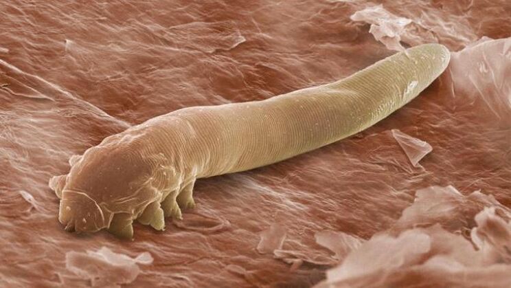worms that live under human skin