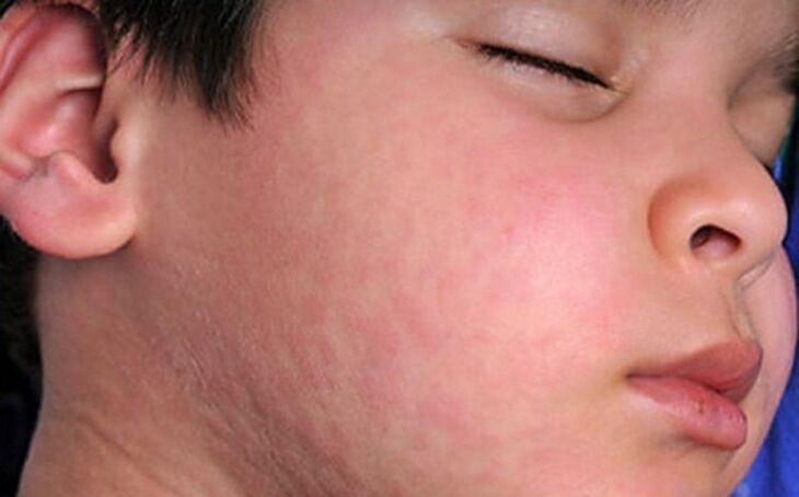 Allergic rash on the skin - a symptom of the presence of parasitic worms in the body